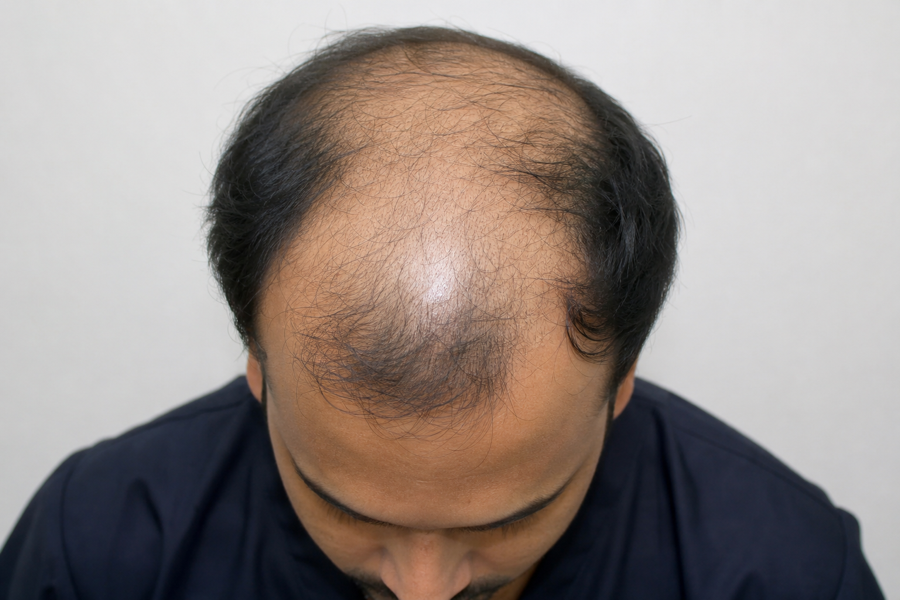 Amit K. before hair transplant