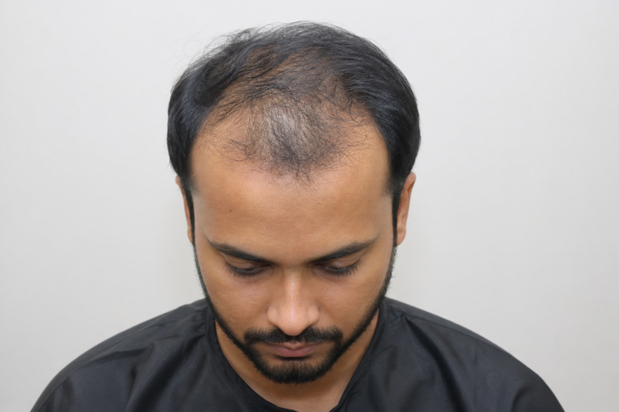 Rahul S. before GFC therapy