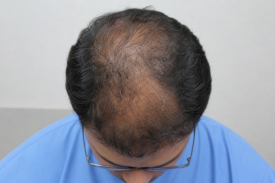 Vikram M. before DHI transplant